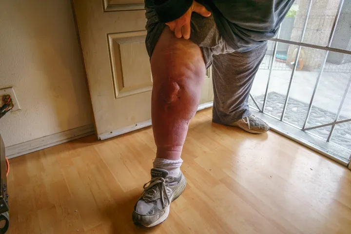 Junior shows his knee, several months after surgery. He now walks with a cain. (Photographed by David Reeve)